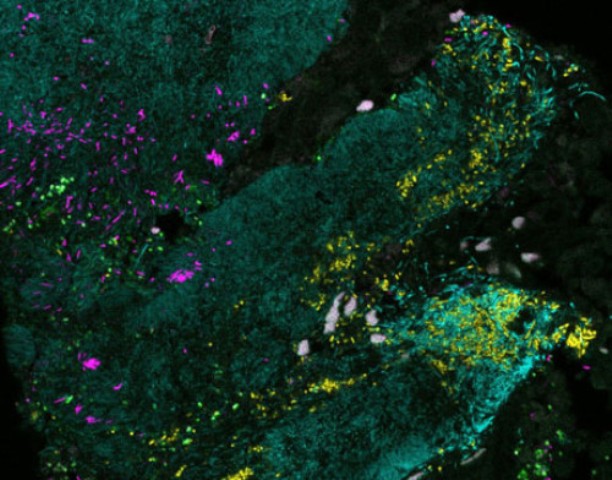 biofilm-bakteri-kanker-usus-besar-131214 biofilm bakteri, kanker usus besar
