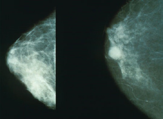 mammografi, kanker payudara